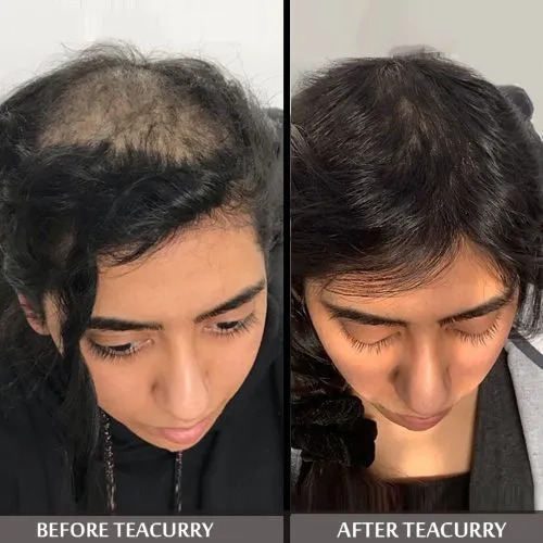 Anti Bald Tea for Men, Women - For Bald Spots & Pattern Baldness