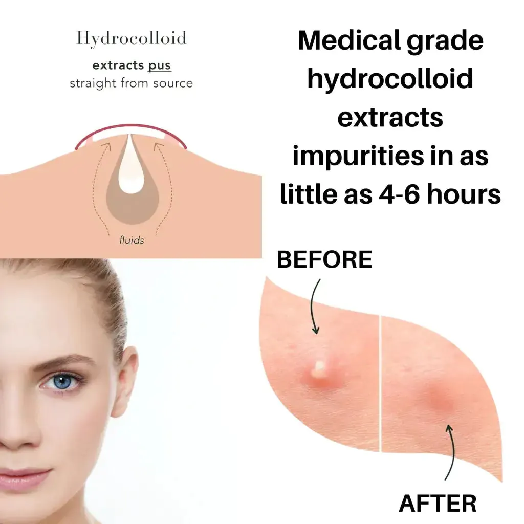 Glow In The Dark Pimple Patches - Hydrocolloid Acne Treatment, 36 Count, Fast Healing & Vegan
