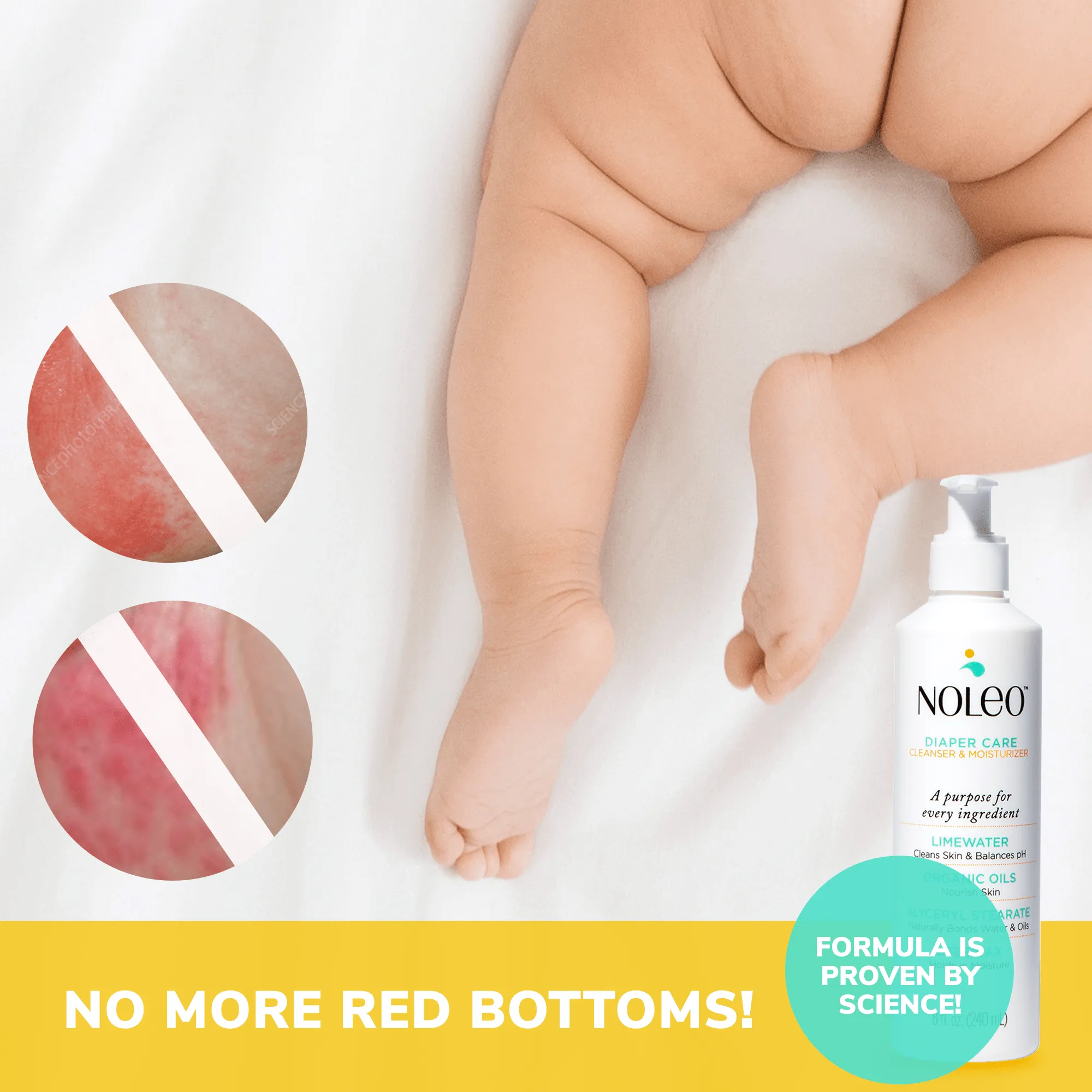 NOLEO DUO - Diaper Rash Treatment for Butt Rash